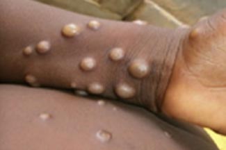Monkeypox: Symptoms and Treatment