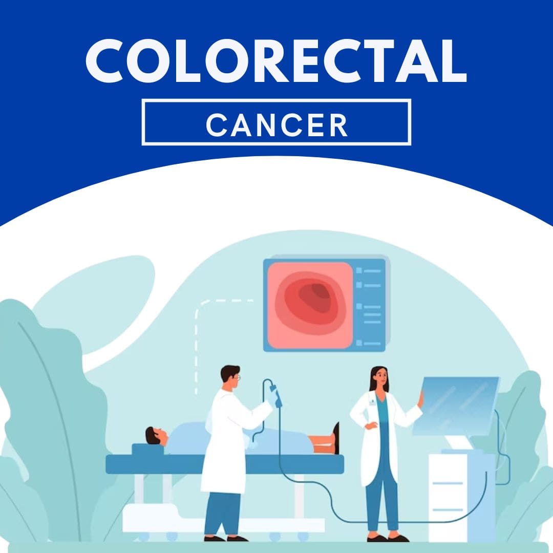 Colorectal Cancer